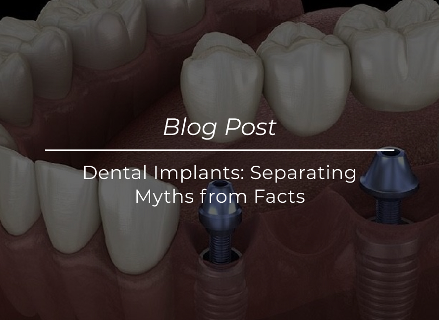 Dental Implants Separating Myths from Facts