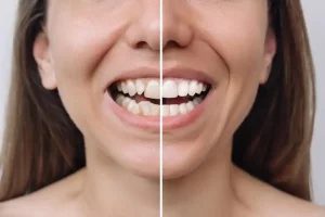 What are Dental Veneers